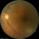 Multifocal CSCR Multifocal CSCR